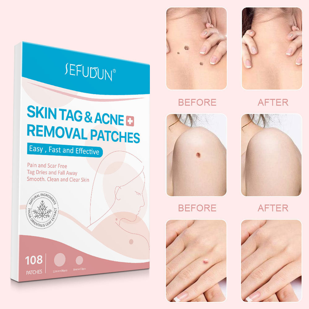 Acne Skin Tag Remover Beauty Acne Patch Wart Removal Stickers Removal Care Invisible Blackhead Skin Patch Acne Skin Tag Remover Beauty Acne Patch Wart Removal Stickers Removal Care Invisible Blackhead Skin Patch